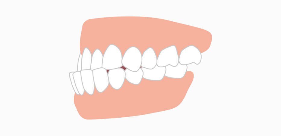 受け口（反対咬合、下顎前突）