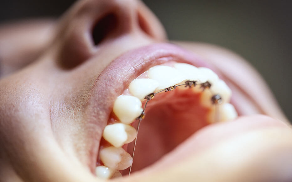 歯の裏側から矯正する「舌側矯正」